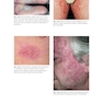 Skin Disease: Diagnosis and Treatment 4th Edition 2018