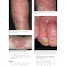 Skin Disease: Diagnosis and Treatment 4th Edition 2018