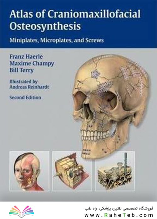 Atlas of Craniomaxillofacial Osteosynthesis : Microplates, Miniplates,and Screws