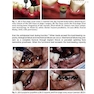 Implant Procedures for the General Dentist, An Issue of Dental Clinics of North America