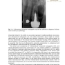 Implant Procedures for the General Dentist, An Issue of Dental Clinics of North America