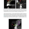 Implant Procedures for the General Dentist, An Issue of Dental Clinics of North America