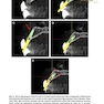 Implant Procedures for the General Dentist, An Issue of Dental Clinics of North America