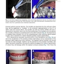 Implant Procedures for the General Dentist, An Issue of Dental Clinics of North America