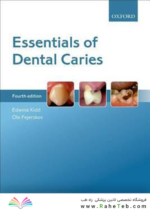 Essentials of Dental Caries
