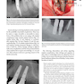 Dental Implant Complications: Etiology, Prevention, and Treatment 2nd Edition