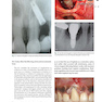 Dental Implant Complications: Etiology, Prevention, and Treatment 2nd Edition