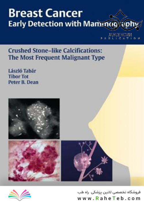 Breast Cancer: Early Detection with Mammography: Crushed Stone-like Calcifications: The Most Frequent Malignant Type 1st Edicion 2008