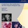 Breast Cancer: Early Detection with Mammography: Crushed Stone-like Calcifications: The Most Frequent Malignant Type 1st Edicion 2008