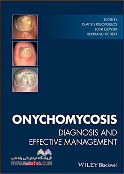 Onychomycosis: Diagnosis and Effective Management 1st Edition2018