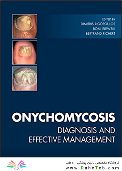 Onychomycosis: Diagnosis and Effective Management 1st Edition2018