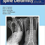 Neuromuscular Spine Deformity 1st Edition2018 تغییر شکل عضله عصبی عضلانی