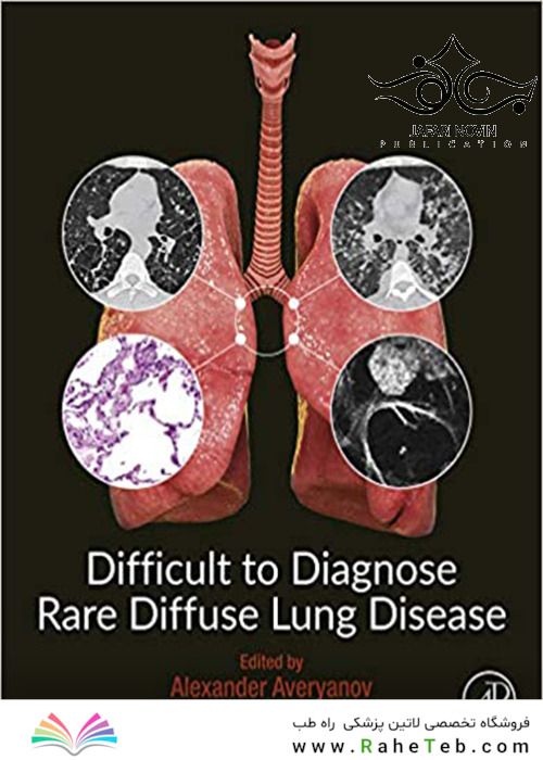 Difficult to Diagnose Rare Diffuse Lung Disease2019 تشخیص بیماری نادر ریوی