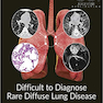 Difficult to Diagnose Rare Diffuse Lung Disease2019 تشخیص بیماری نادر ریوی