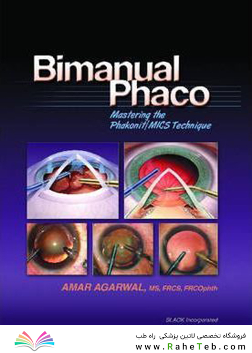 Bimanual Phaco: Mastering the Phakonit/MICS Technique2004