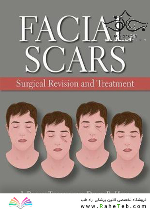 Facial Scars: Surgical Revision and Treatment2017