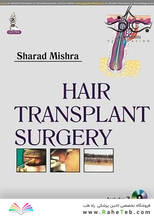 Hair Transplant Surgery 1st Edition 2014