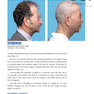 Step by Step Hair Transplantation 2019 کاشت مو به صورت مرحله به مرحله