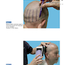 Step by Step Hair Transplantation 2019 کاشت مو به صورت مرحله به مرحله
