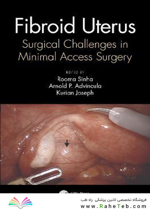 Fibroid Uterus: Surgical Challenges in Minimal Access Surgery2020فیبروئید رحم