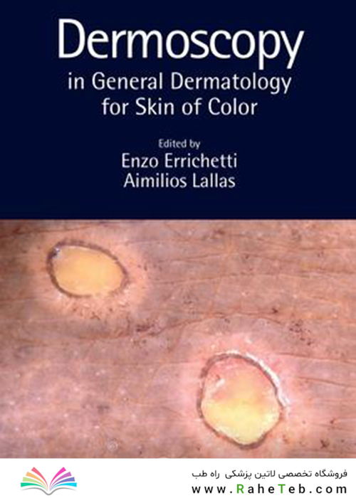 Dermoscopy in General Dermatology for Skin of Color2021