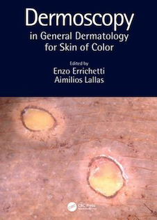 عکس Dermoscopy in General Dermatology for Skin of Color2021