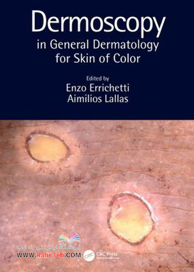 Dermoscopy in General Dermatology for Skin of Color2021