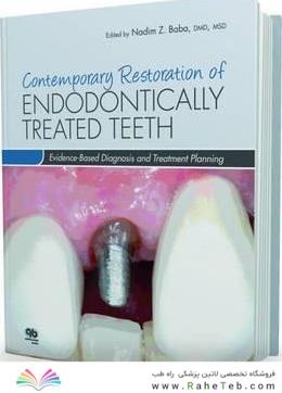 Contemporary Restoration of Endodontically Treated Teeth