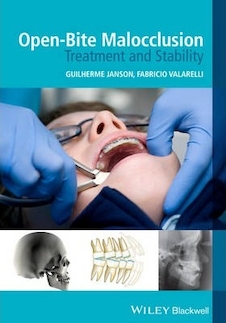 عکس Open-Bite Malocclusion : Treatment and Stability
