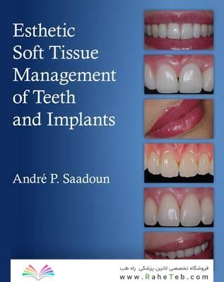 Esthetic Soft Tissue Management of Teeth and Implants