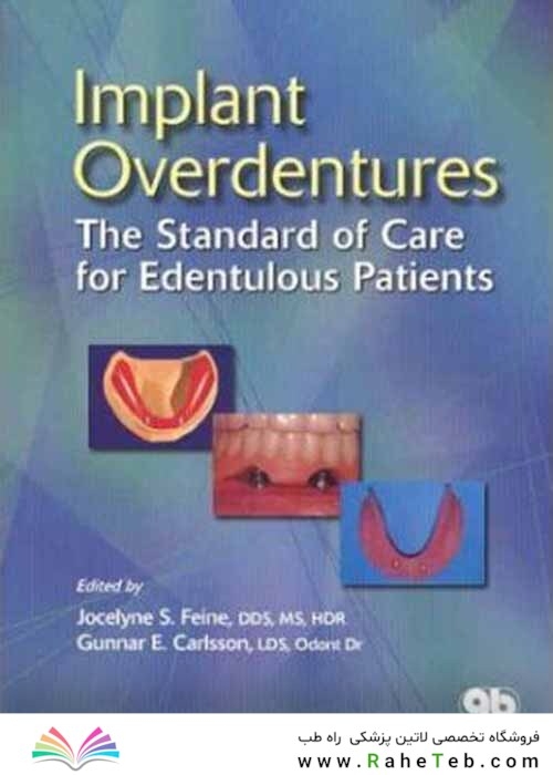 Implant Overdentures as the Standard of Care for Edentulous Patients