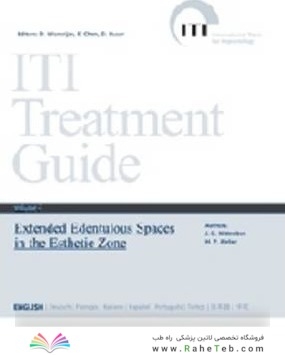 ITI Treatment Guide: Extended Edentulous Spaces in the Esthetic Zone 6