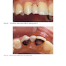 Rbfdps : Resin-Bonded Fixed Dental Prostheses: Minimally Invasive - Esthetic - Reliable