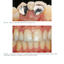 Rbfdps : Resin-Bonded Fixed Dental Prostheses: Minimally Invasive - Esthetic - Reliable