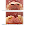 Rbfdps : Resin-Bonded Fixed Dental Prostheses: Minimally Invasive - Esthetic - Reliable