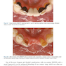 Rbfdps : Resin-Bonded Fixed Dental Prostheses: Minimally Invasive - Esthetic - Reliable