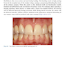 Rbfdps : Resin-Bonded Fixed Dental Prostheses: Minimally Invasive - Esthetic - Reliable