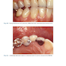 Rbfdps : Resin-Bonded Fixed Dental Prostheses: Minimally Invasive - Esthetic - Reliable