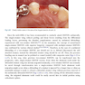 Rbfdps : Resin-Bonded Fixed Dental Prostheses: Minimally Invasive - Esthetic - Reliable