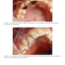 Rbfdps : Resin-Bonded Fixed Dental Prostheses: Minimally Invasive - Esthetic - Reliable