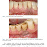 Rbfdps : Resin-Bonded Fixed Dental Prostheses: Minimally Invasive - Esthetic - Reliable