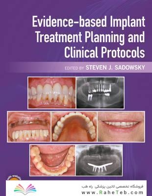 Evidence-based Implant Treatment Planning and Clinical Protocols