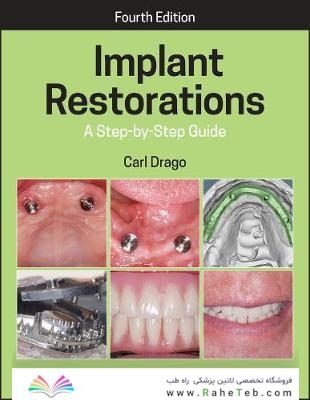 Implant Restorations : A Step-by-Step Guide