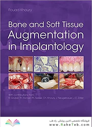 Bone and Soft Tissue Augmentation in Implantology 2022