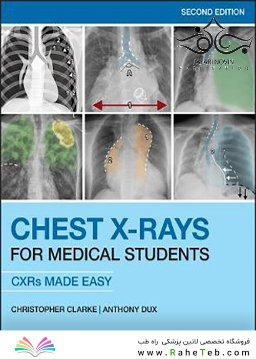 Chest X-Rays for Medical Students: CXRs Made Easy 2nd Edition2020