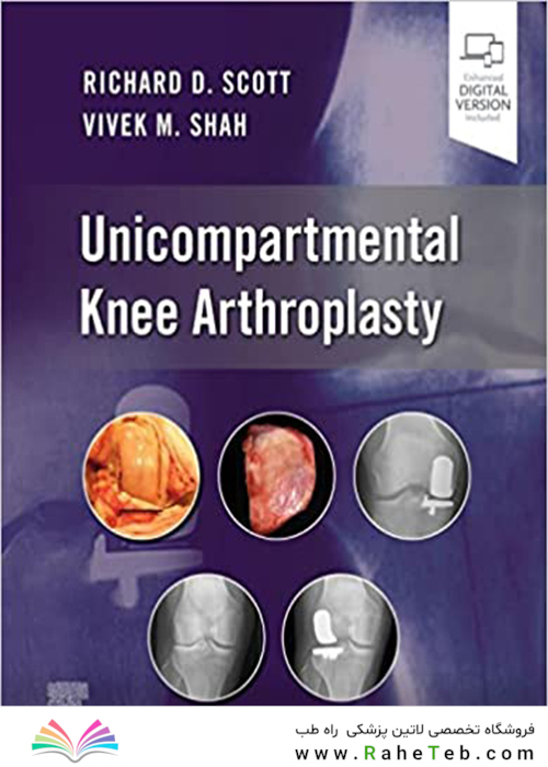 Unicompartmental Knee Arthroplasty