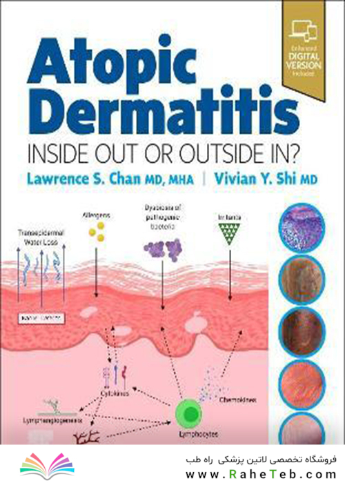 Atopic Dermatitis: Inside Out or Outside In