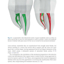 Shaping for Cleaning the Root Canals : A Clinical-Based Strategy 2022