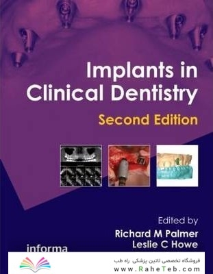Implants in Clinical Dentistry 2nd Edición
