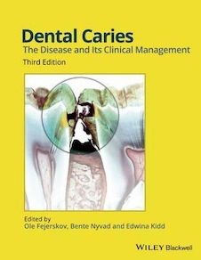 عکس Dental Caries: The Disease and its Clinical Management 3rd Edición